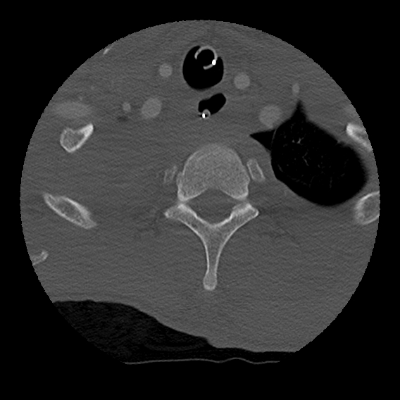 File:Bilateral perched facets with cord injury (Radiopaedia 45587-49713 Axial bone window 104).jpg
