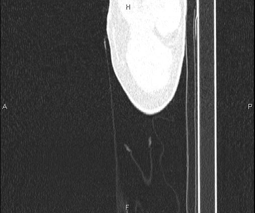 Bilateral pulmonary AVM (Radiopaedia 83134-97505 Sagittal lung window 118).jpg