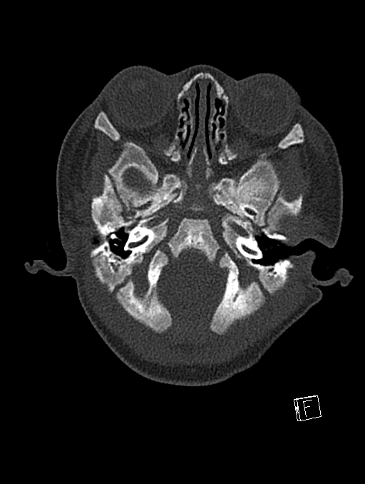 Bilateral subdural hemorrhage and parietal skull fracture (Radiopaedia 26058-26192 Axial bone window 112).png