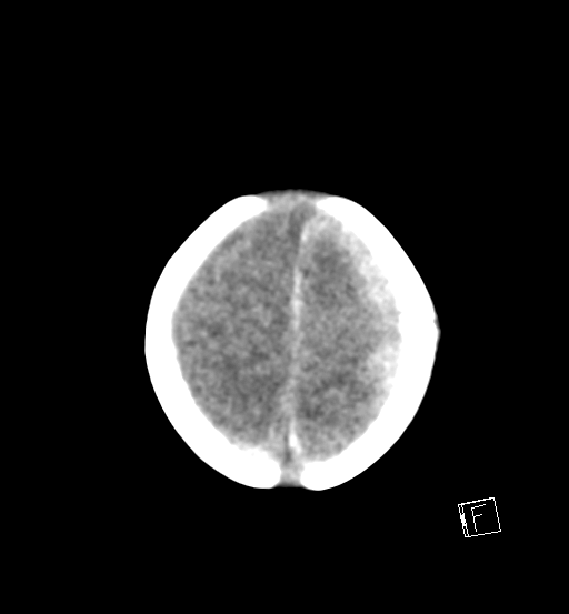 File:Bilateral subdural hemorrhage and parietal skull fracture (Radiopaedia 26058-26192 Axial non-contrast 3).png