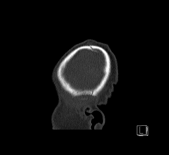 Bilateral subdural hemorrhage and parietal skull fracture (Radiopaedia 26058-26192 Sagittal bone window 92).png