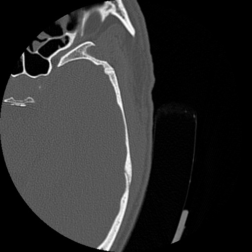 Bilateral temporal bone fractures (Radiopaedia 29482-29970 D 150).jpg