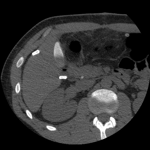 Bile leak from liver traumatic laceration (Radiopaedia 63463-72077 Axial Biliscopin 57).jpg