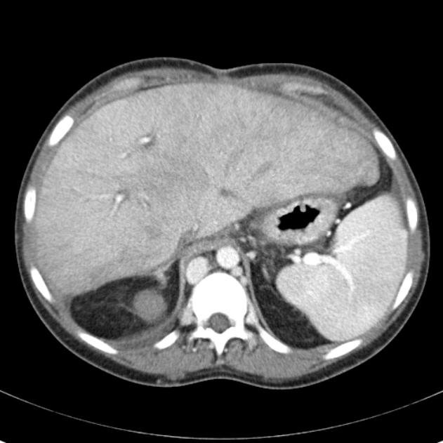 Biliary necrosis - liver transplant (Radiopaedia 21876-21846 B 16).jpg