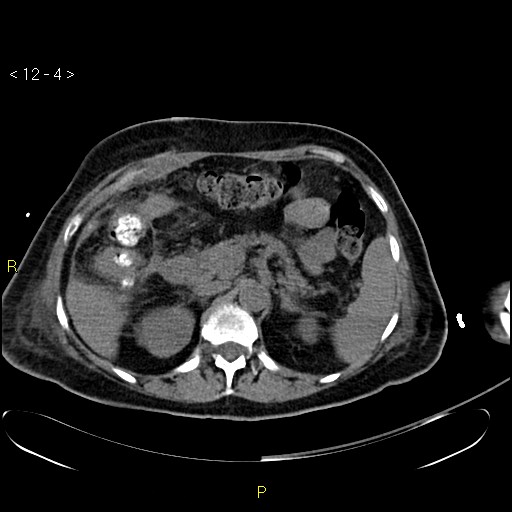 File:Biloma with drainage into the colon (Radiopaedia 20032-20068 B 13).jpg