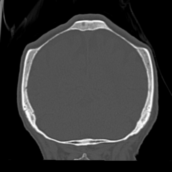Biparietal osteodystrophy (Radiopaedia 46109-50463 Coronal bone window 83).jpg