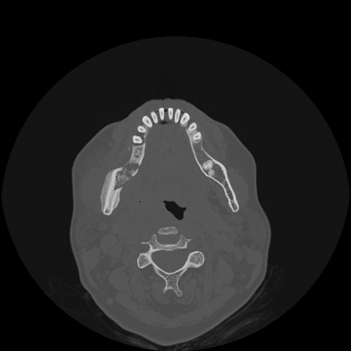 File:Bisphosphonate-related osteonecrosis of the jaw (Radiopaedia 71324-81642 Axial bone window 63).jpg