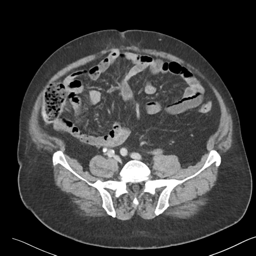 File:Bladder papillary urothelial carcinoma (Radiopaedia 48119-52951 Axial 38).png