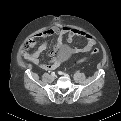 File:Bladder papillary urothelial carcinoma (Radiopaedia 48119-52951 Axial 40).png