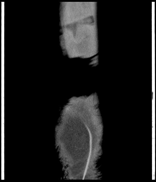 Bladder rupture post renal biopsy (Radiopaedia 30863-31572 Coronal non-contrast 57).jpg