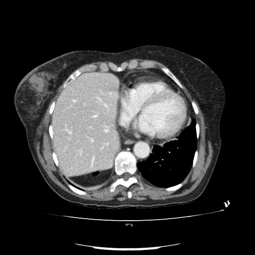 File:Bladder tumor detected on trauma CT (Radiopaedia 51809-57609 B 16).jpg