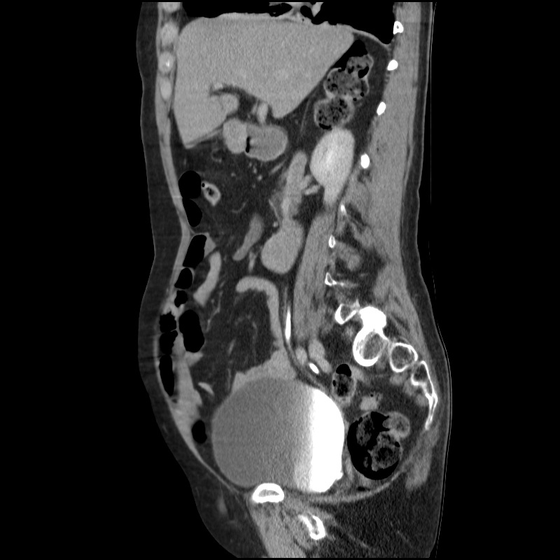 Bladder tumor detected on trauma CT (Radiopaedia 51809-57609 E 46).jpg