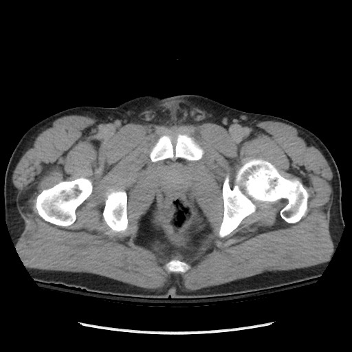 File:Blunt abdominal trauma with solid organ and musculoskelatal injury with active extravasation (Radiopaedia 68364-77895 Axial C+ delayed 138).jpg
