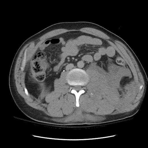 Blunt abdominal trauma with solid organ and musculoskelatal injury with active extravasation (Radiopaedia 68364-77895 Axial C+ delayed 71).jpg