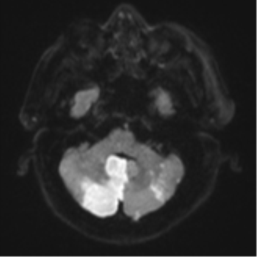 Blunt cerebrovascular injury (Radiopaedia 53682-59745 Axial DWI 38).png