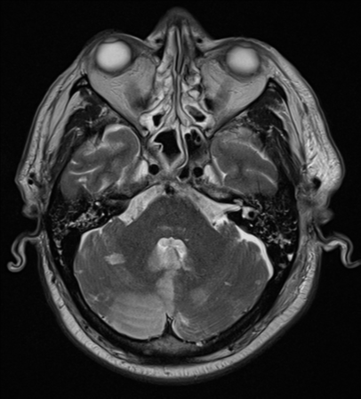 File:Blunt cerebrovascular injury (Radiopaedia 53682-59745 Axial T2 9).png