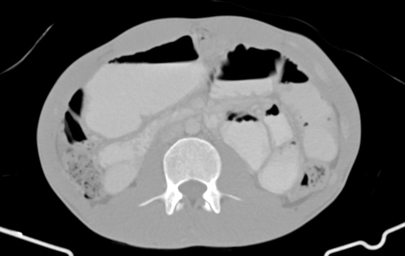 Blunt injury to the small bowel (Radiopaedia 74953-85987 Axial Wide 39).jpg