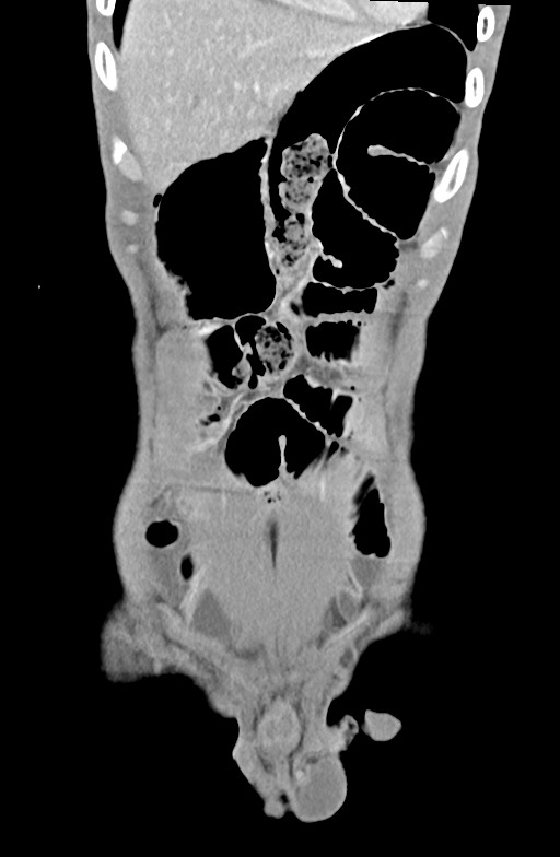 Blunt injury to the small bowel (Radiopaedia 74953-85987 B 21).jpg