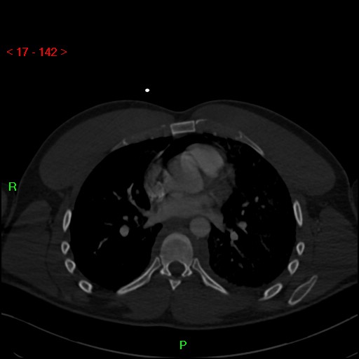 Blunt thoracic trauma (Radiopaedia 73454-84221 Axial bone window 54).jpg