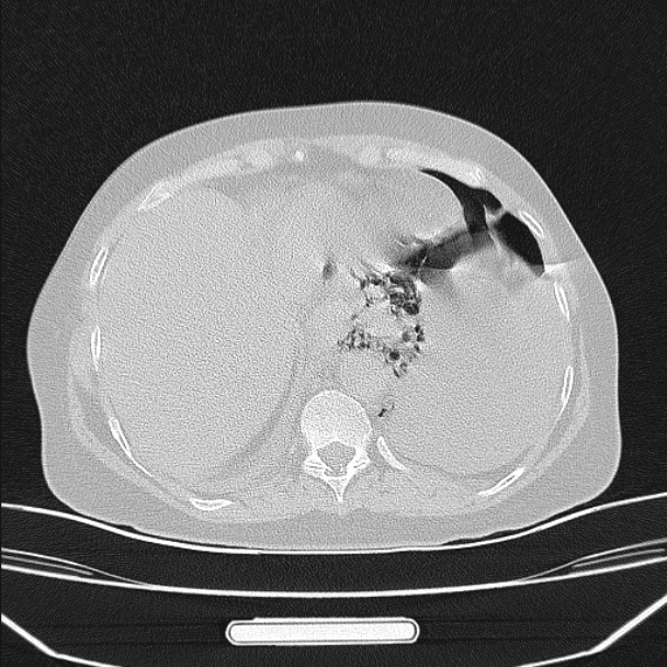 Boerhaave syndrome (Radiopaedia 45644-49799 Axial lung window 94).jpg