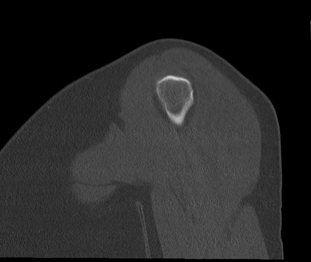 Bony Bankart and Hill-Sachs lesions (Radiopaedia 33622-34727 Sagittal bone window 13).png