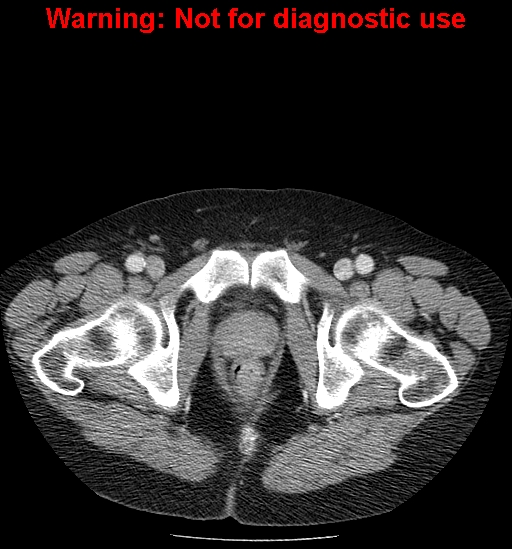 File:Bosniak renal cyst - type IV (Radiopaedia 23402-23466 D 81).jpg