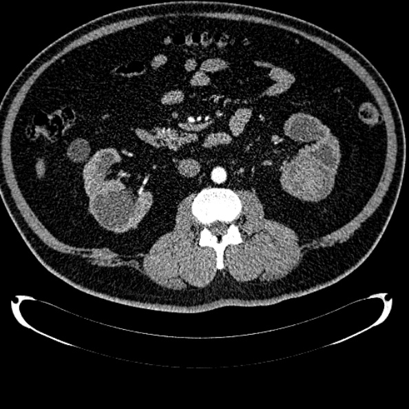 Bosniak renal cyst - type IV (Radiopaedia 24244-24518 B 166).jpg