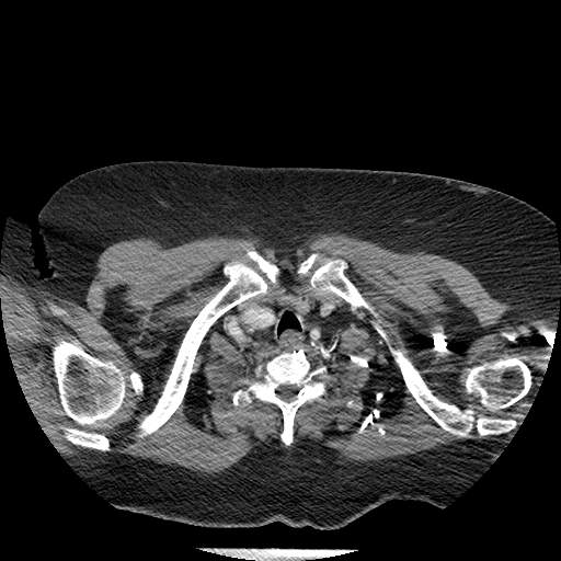 Bovine aortic arch - right internal mammary vein drains into the superior vena cava (Radiopaedia 63296-71875 A 3).jpg