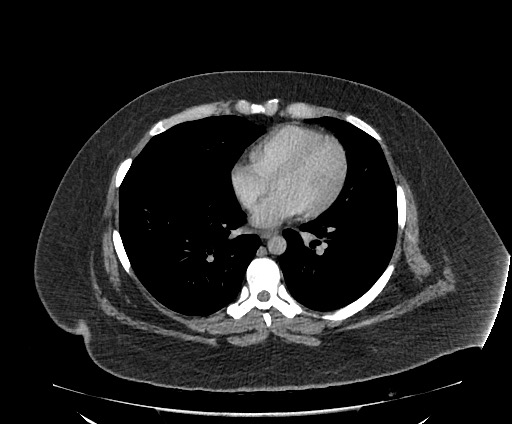Bowel and splenic infarcts in acute lymphocytic leukemia (Radiopaedia 61055-68913 A 8).jpg