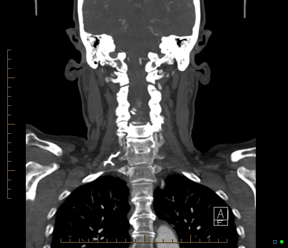 Brachiocephalic trunk stenosis (Radiopaedia 87242-103519 B 47).jpg