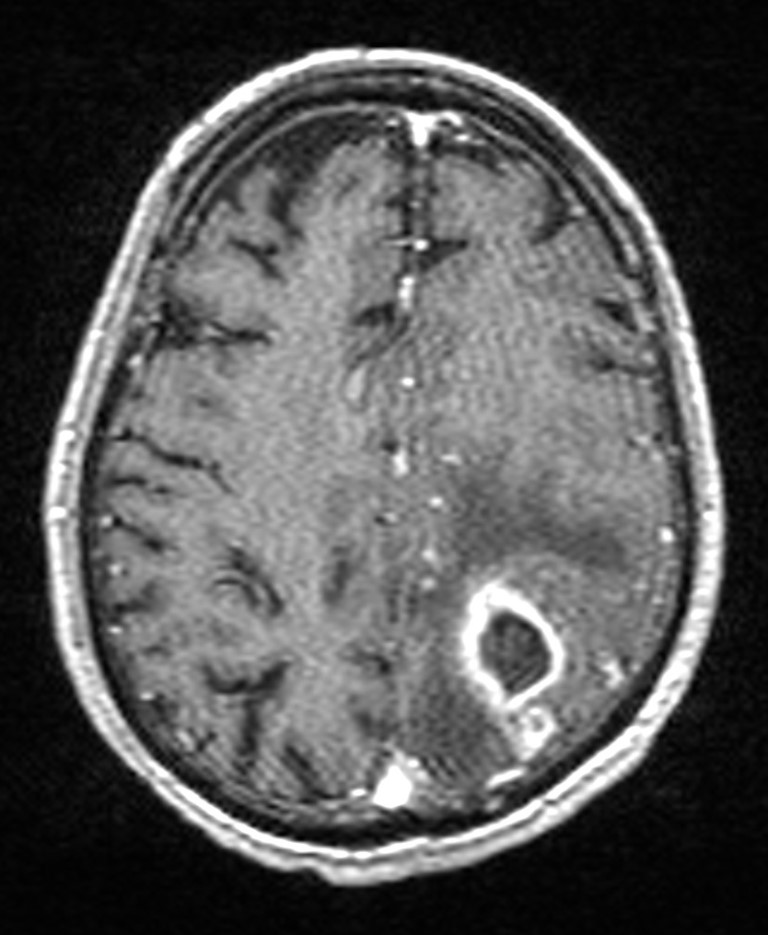 Brain abscess with dual rim sign (Radiopaedia 87566-103938 Axial T1 C+ 117).jpg
