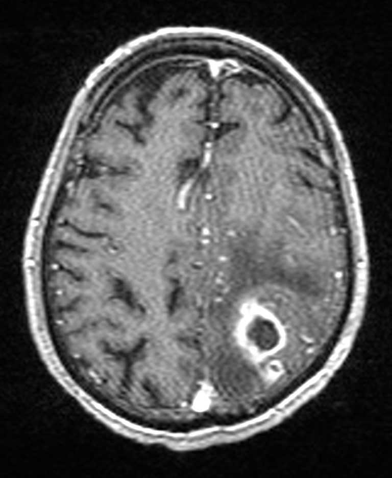 Brain abscess with dual rim sign (Radiopaedia 87566-103938 Axial T1 C+ 118).jpg