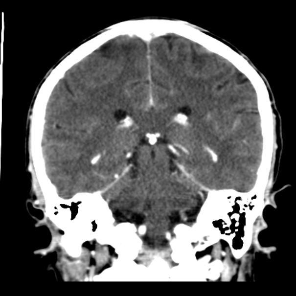 Brain metastases from lung cancer (Radiopaedia 24480-24781 Coronal C+ delayed 39).jpg