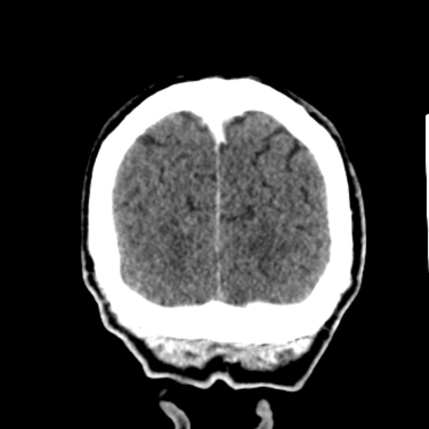 Brain metastases from lung cancer (Radiopaedia 27849-28092 Coronal C+ delayed 61).jpg