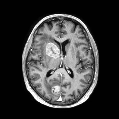 Brain metastases from lung cancer (Radiopaedia 83839-99028 Axial T1 C+ 36).jpg