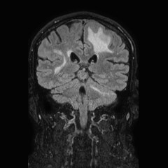File:Brain metastases from lung cancer (Radiopaedia 83839-99028 Coronal FLAIR 50).jpg