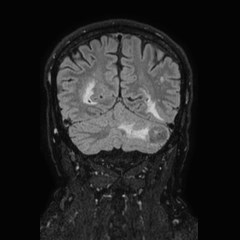 Brain metastases from lung cancer (Radiopaedia 83839-99028 Coronal FLAIR 61).jpg