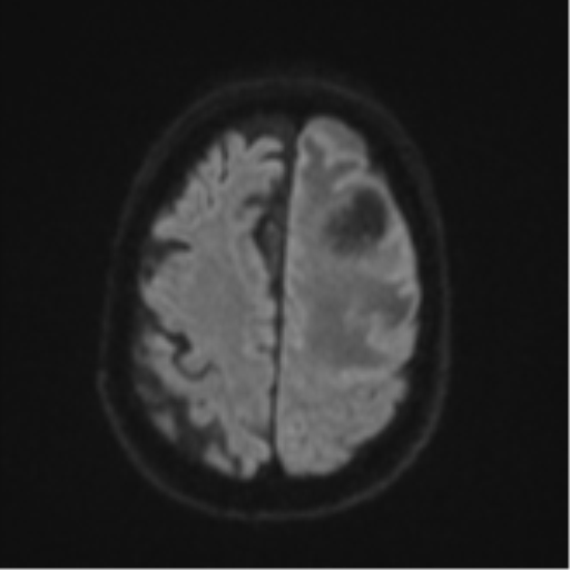 Brain metastasis (lung cancer) (Radiopaedia 48289-53179 Axial DWI 50).png