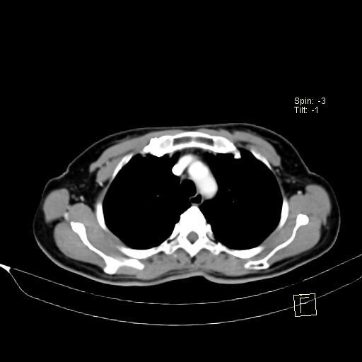 Brain metastasis as initial presentation of non-small cell lung cancer (Radiopaedia 65122-74127 A 13).jpg