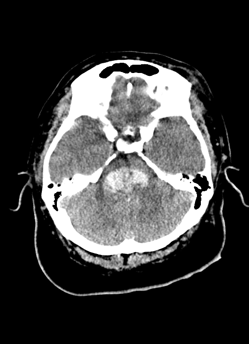 Brainstem hemorrhage (Radiopaedia 81294-94976 Axial non-contrast 44).jpg