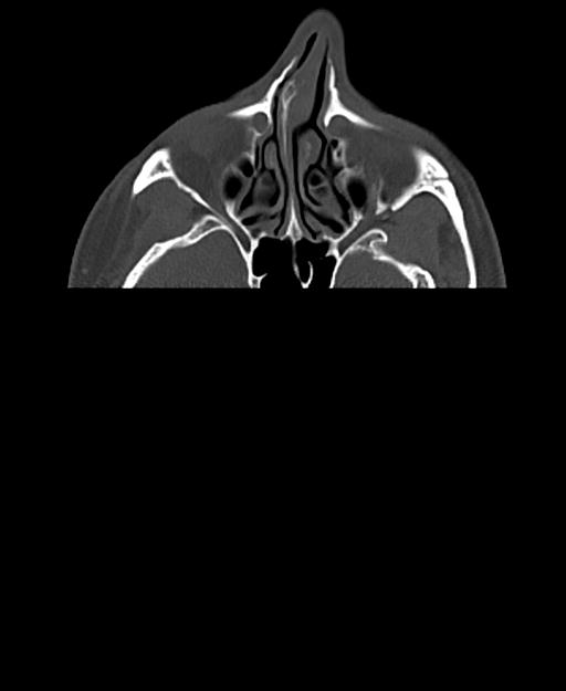 Branchial cleft cyst (Radiopaedia 31167-31875 Axial bone window 2).jpg