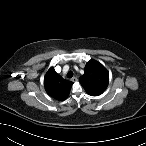 Breast carcinoma with pathological hip fracture (Radiopaedia 60314-67974 A 12).jpg