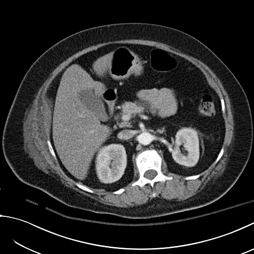File:Breast carcinoma with pathological hip fracture (Radiopaedia 60314-67974 A 56).jpg