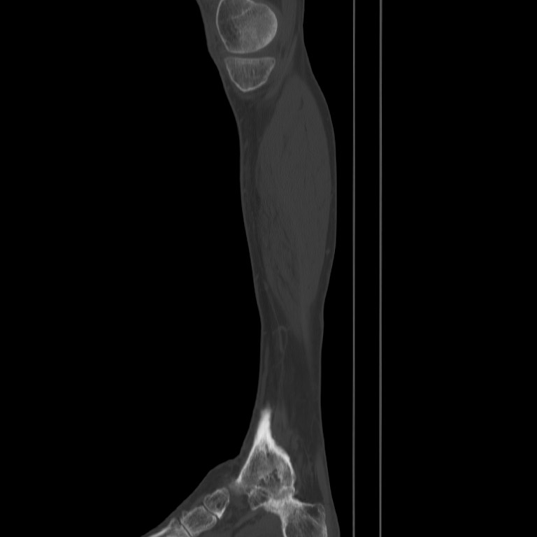 Brodie abscess - tibia (Radiopaedia 66028-75204 Sagittal bone window 1).jpg