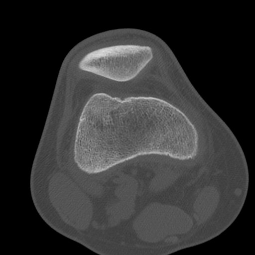 Brodie abscess of the tibia (Radiopaedia 58984-66250 Axial bone window 24).jpg
