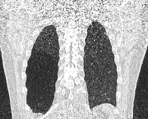 Bronchial atresia (Radiopaedia 58271-65417 Coronal lung window 51).jpg