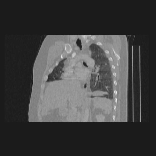 Bronchial atresia (Radiopaedia 60685-68439 Sagittal lung window 47).jpg