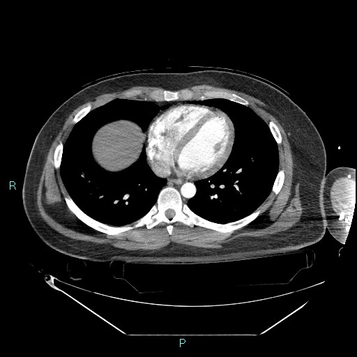 Bronchial carcinoid tumor (Radiopaedia 78272-90870 B 80).jpg