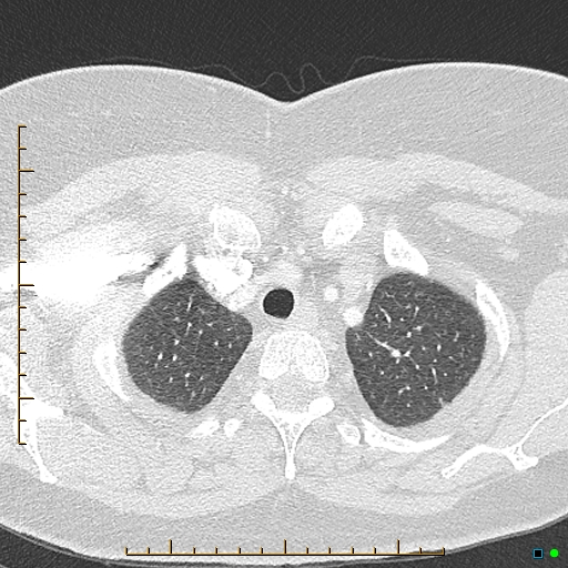 File:Bronchial diverticula (Radiopaedia 79512-92676 Axial lung window 16).jpg