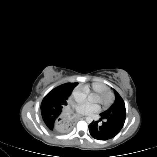 Bronchial mucoepidermoid carcinoma (Radiopaedia 57023-63895 Axial 59).jpg